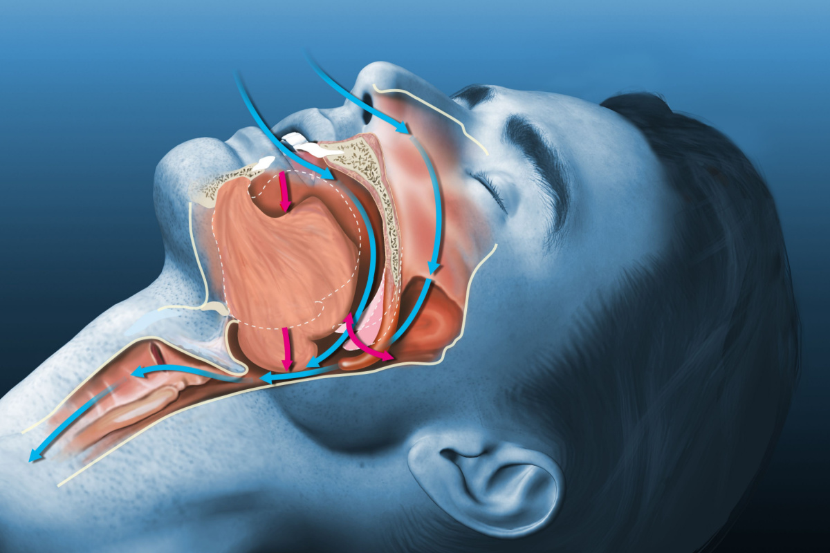 Sleep Apnea & strokes West Orange
