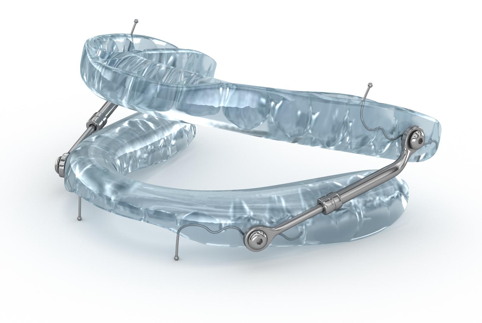Clear upper and lower dental trays connected by metal arms and small wire components.